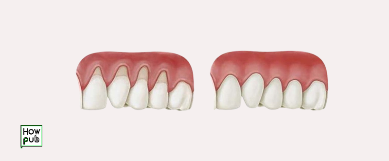 Receding gums before and after treatment